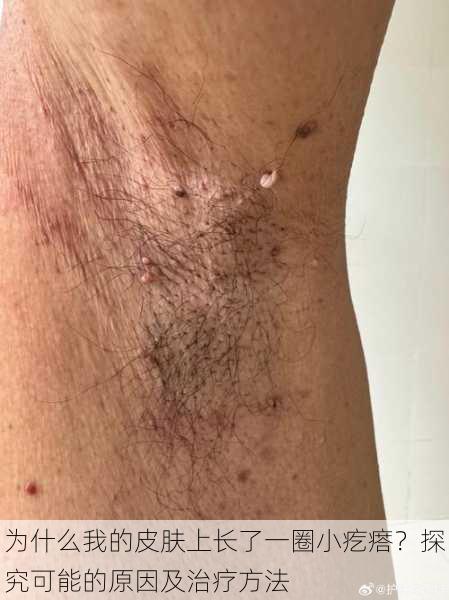 为什么我的皮肤上长了一圈小疙瘩?探究可能的原因及治疗方法